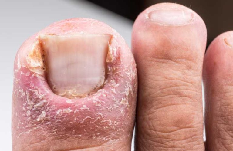 Mycose des ongles de pied : meilleurs traitements naturelles !