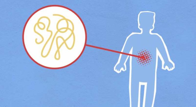 Douleur intestinale : les remèdes efficaces