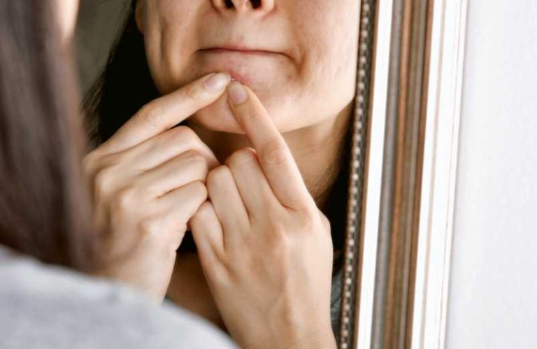 Acné hormonale : comment la reconnaître et y remédier ?