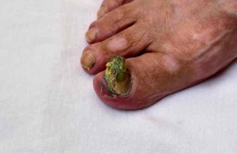 Mélanome ongle pied : quels symptômes et traitements ?