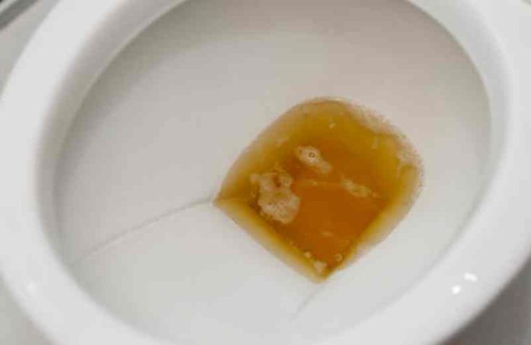 Urine jaune foncé : pourquoi une variation de couleur ?