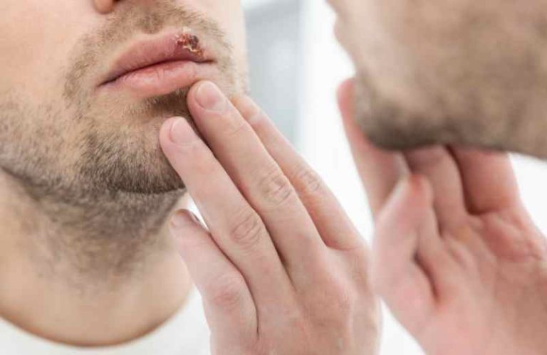 L'herpès : techniques rapides pour réduire les symptômes