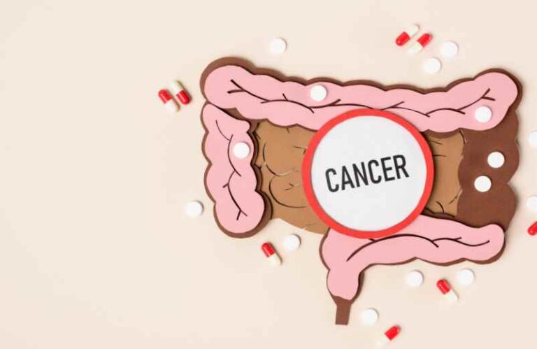 Cancer du côlon stade 4 : un témoignage de lutte