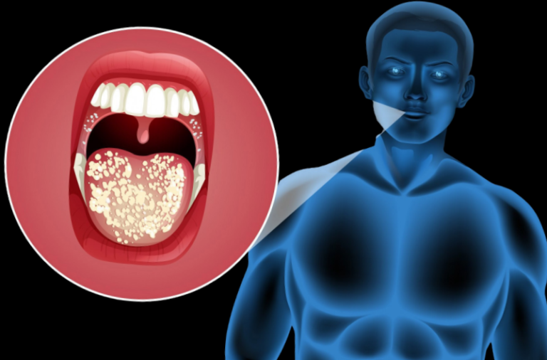 Mycose buccale après antibiotiques : combien de temps pour guérir ?